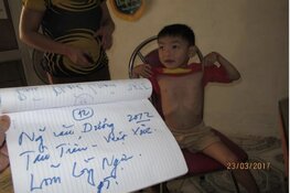 Child Surgery Vietnam maakt een einde aan operatie achterstanden bij kinderen